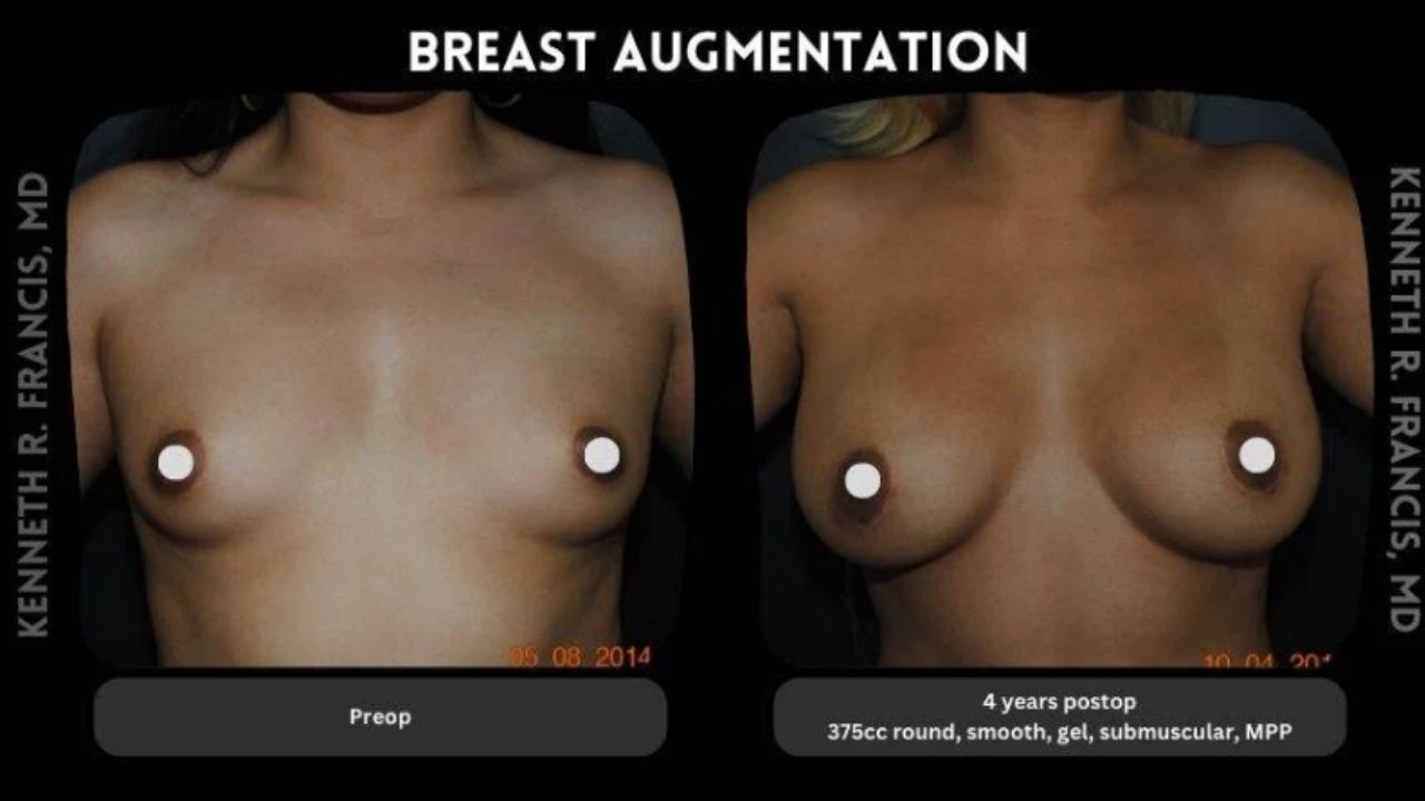 A comparison of a woman's breast.