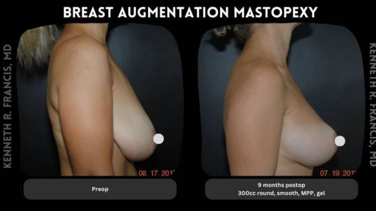 Side-by-side before and after photos of a woman's torso showing breast augmentation mastopexy results at pre-op and 9 months post-op.