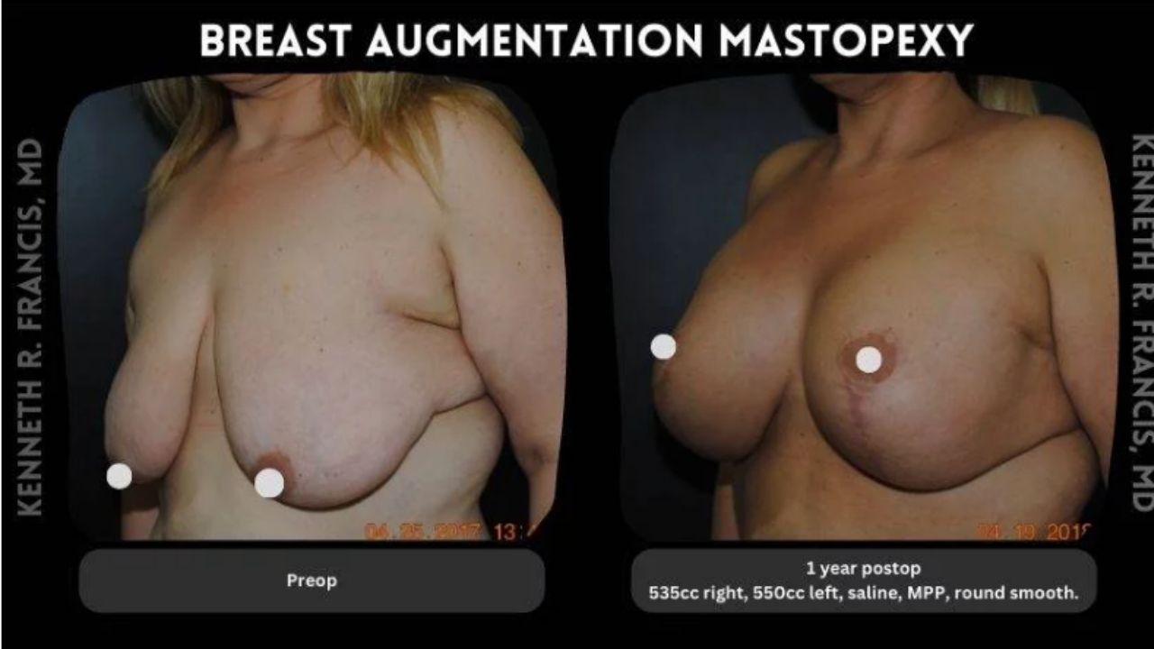 Side-by-side comparison of a woman's chest before and one year after breast augmentation mastopexy, showing enhanced breast size and lift post-surgery.