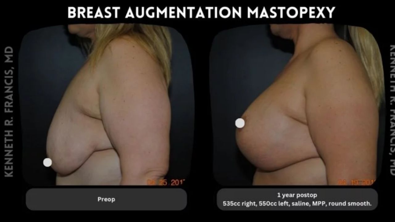 Side-by-side images of a woman before and after breast augmentation mastopexy, showing increased breast volume and lift one year after surgery.