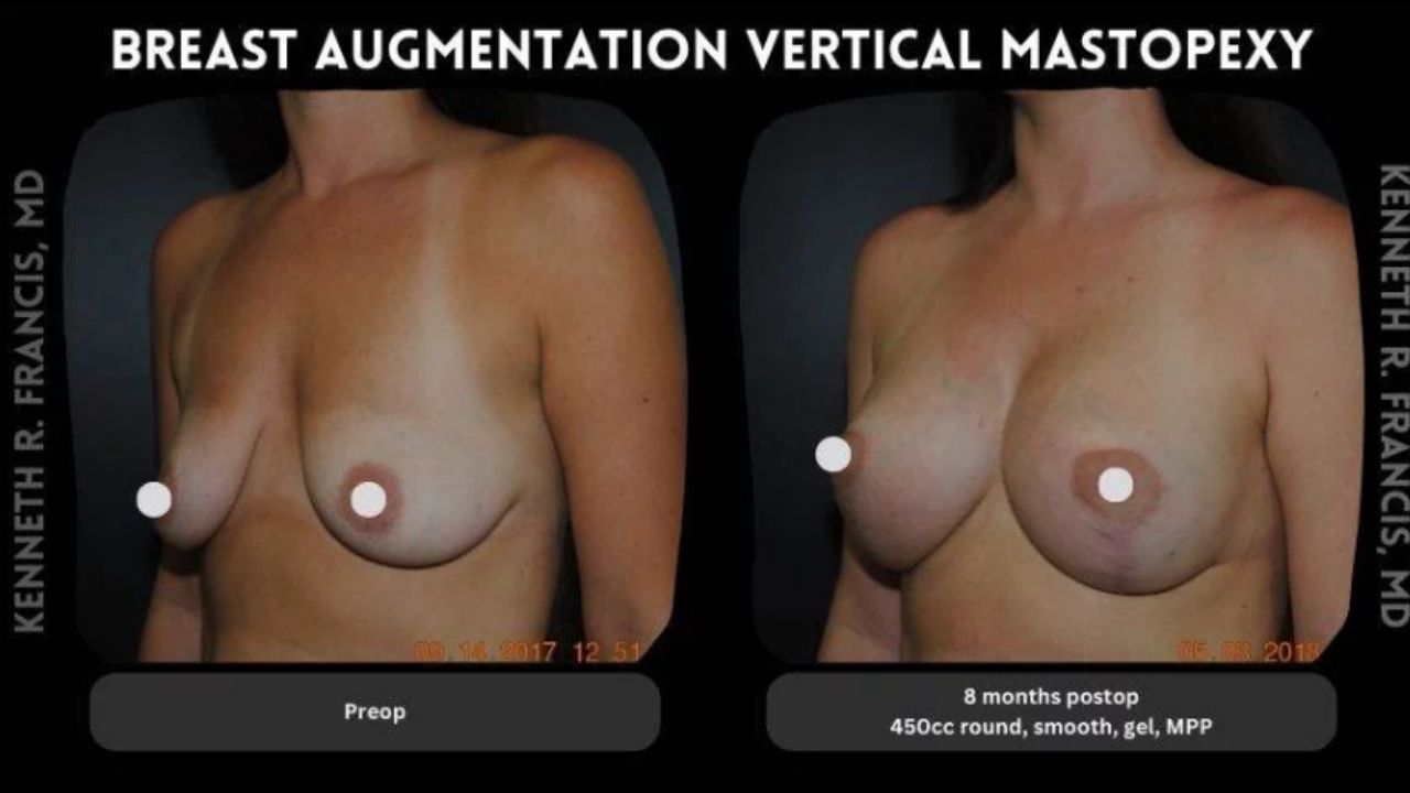 Side-by-side comparison of a woman's chest before and 8 months after breast augmentation and vertical mastopexy surgery.