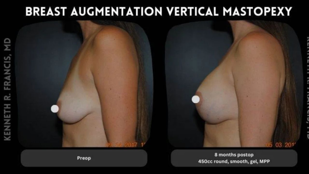 Side-by-side comparison of a woman's torso before and after breast augmentation and vertical mastopexy, showing increased breast size and lift at 8 months post-operation.