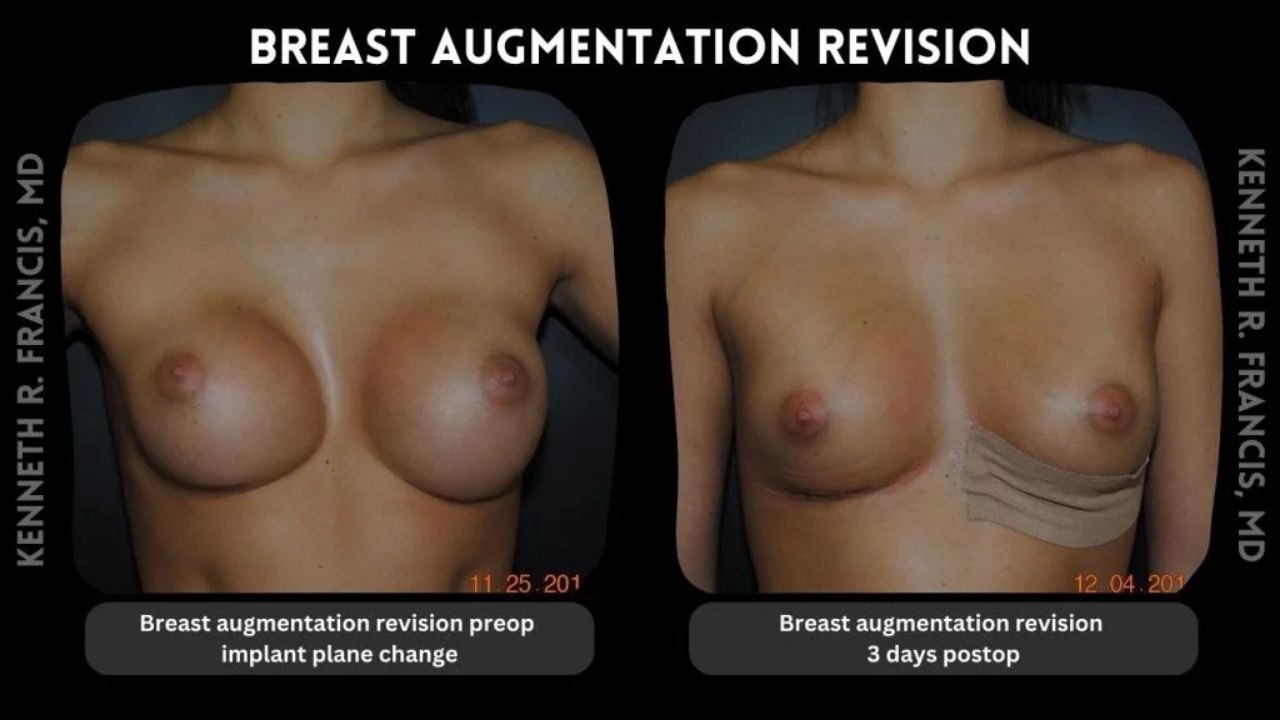 Side-by-side comparison of a woman before and 3 days after breast augmentation revision surgery, showing changes in breast appearance.