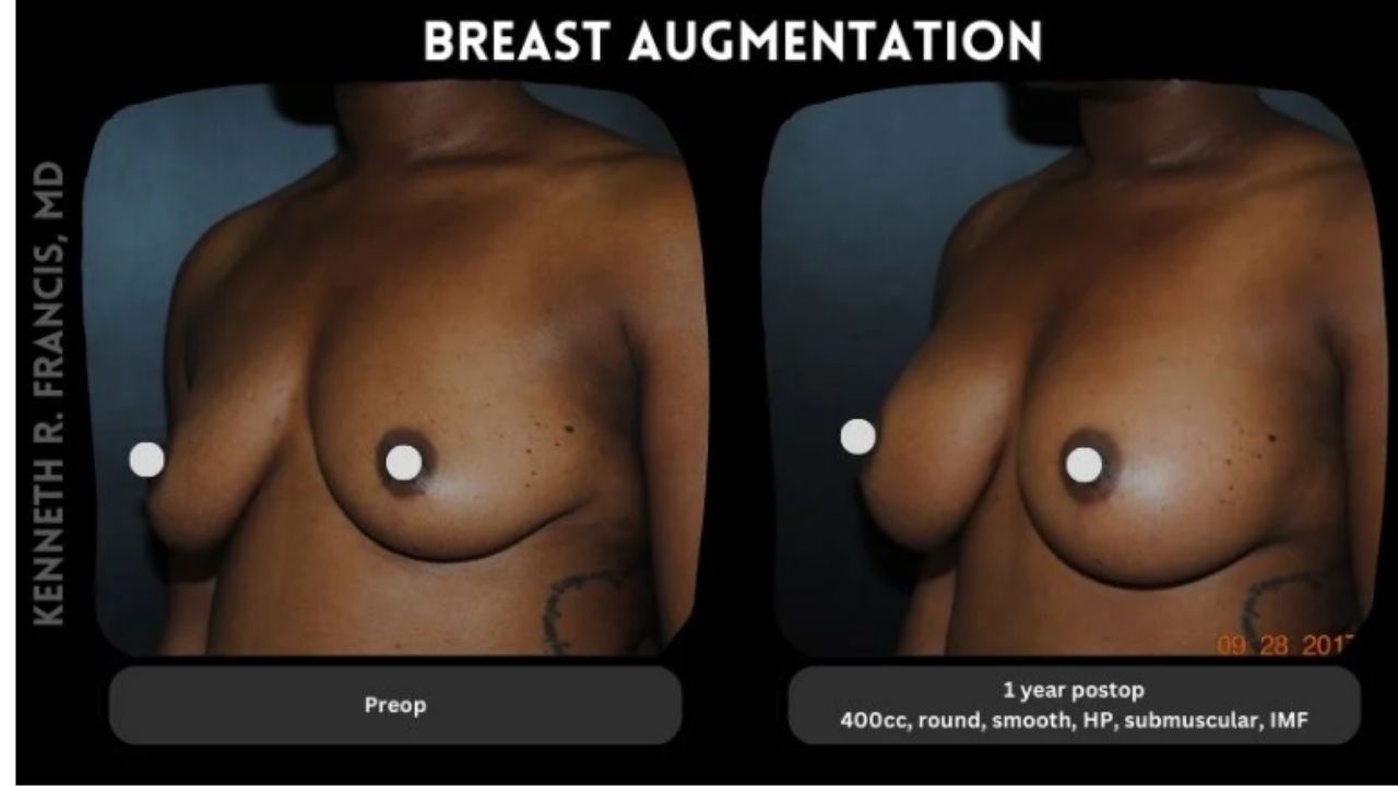 Side-by-side comparison of a person's chest before and one year after breast augmentation surgery with 400cc implants. Pre-op image left; post-op image right.