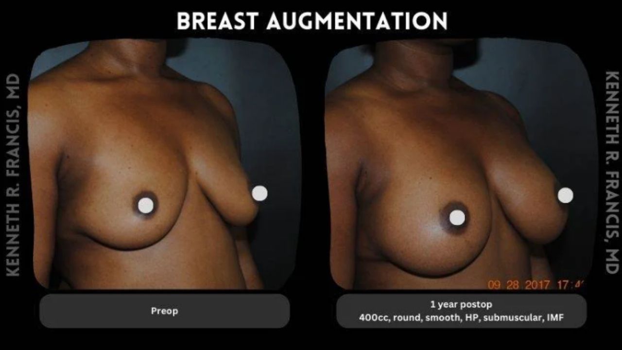 Side-by-side images show a woman's torso before and one year after breast augmentation with 400cc round implants; increased breast size and fullness are visible.
