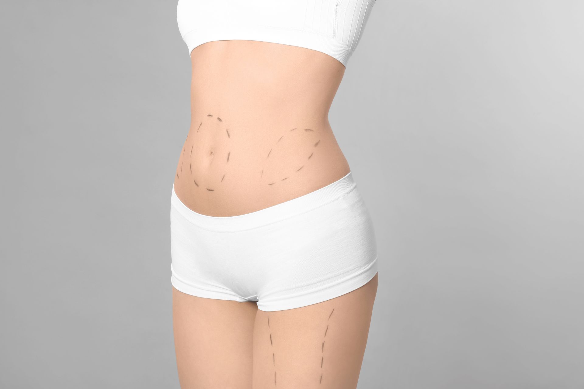 Woman in white underwear with dotted lines drawn on her abdomen, hip, and thigh, indicating areas possibly marked for cosmetic surgery or body contouring.