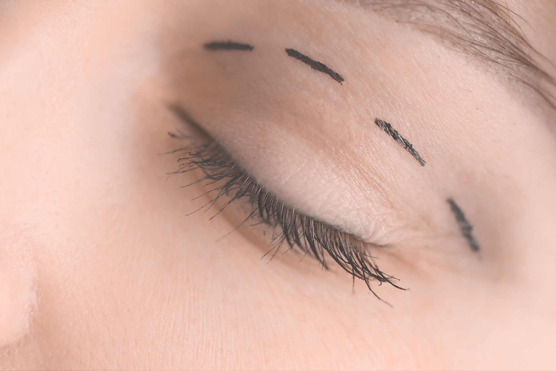 Close-up of a closed eye with three black marker lines drawn on the upper eyelid, likely indicating preparation for a cosmetic procedure or surgery.