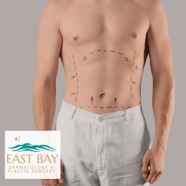 body lift bellmore east bay dermatology and plastic surgery