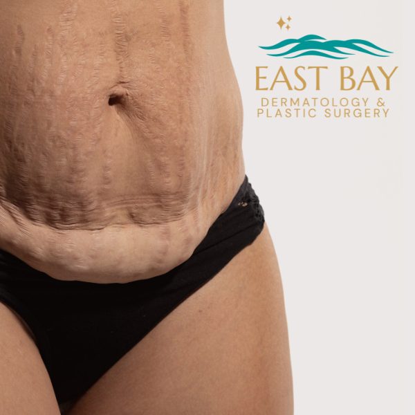 body lift bellmore east bay dermatology