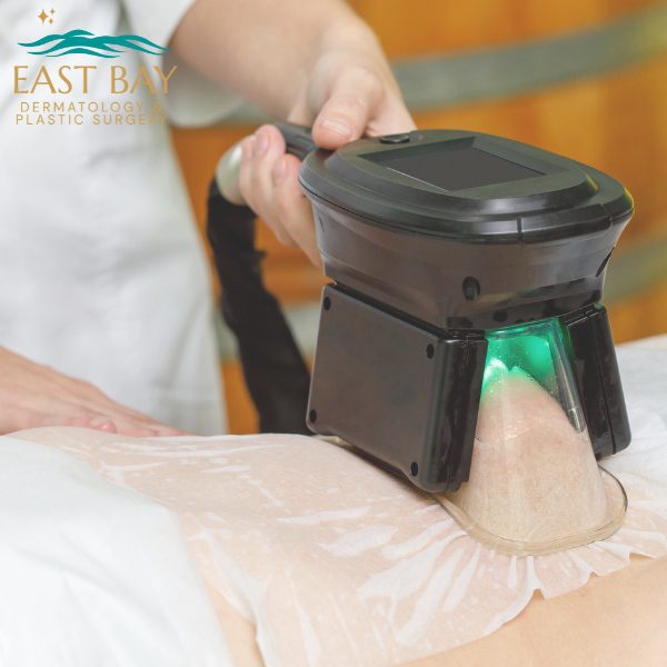 coolsculpting in bellmore