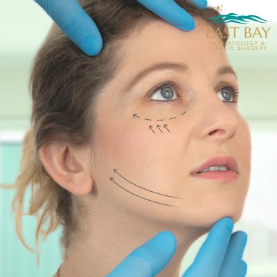 facelift