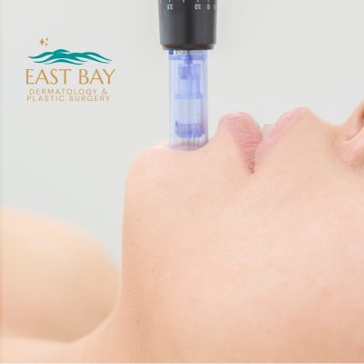 microneedling