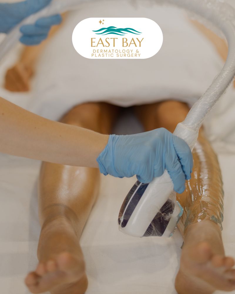 laser hair removal bellmore ny 2