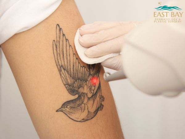 Gloved hands use a laser device to remove a bird tattoo from a person's upper arm. The East Bay Dermatology & Plastic Surgery logo is visible in the corner.