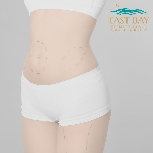 liposuction consultation