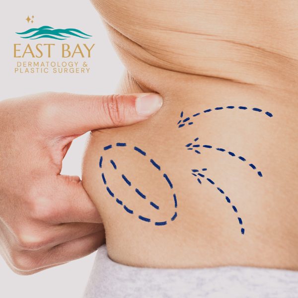 liposuction in bellmore ny east bay dermatology & plastic surgery (1) liposuction in bellmore ny east bay dermatology & plastic surgery (1)