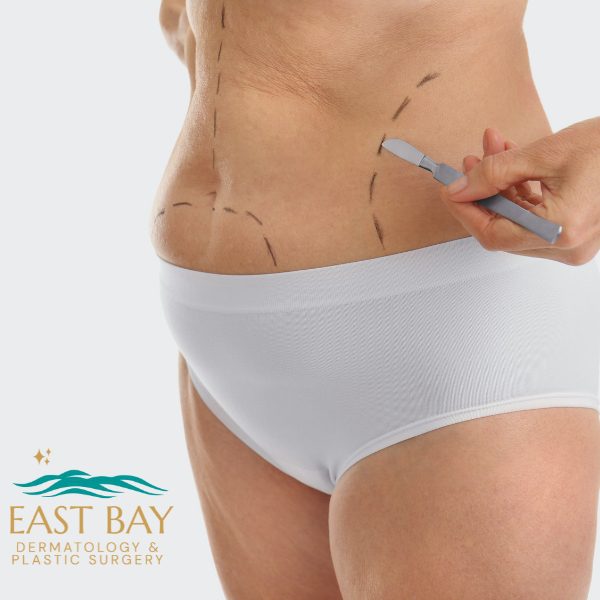liposuction in bellmore ny east bay dermatology & plastic surgery (2)