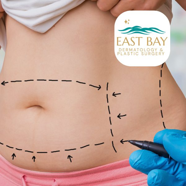 liposuction in bellmore ny east bay dermatology & plastic surgery liposuction in bellmore ny east bay dermatology & plastic surgery
