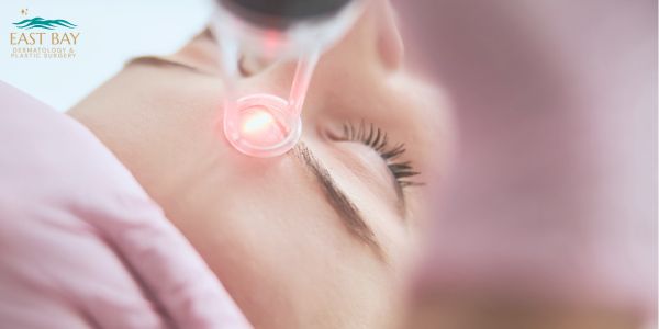 A close-up of a person receiving a laser skin treatment on their face, with the East Bay Dermatology & Plastic Surgery logo in the corner.