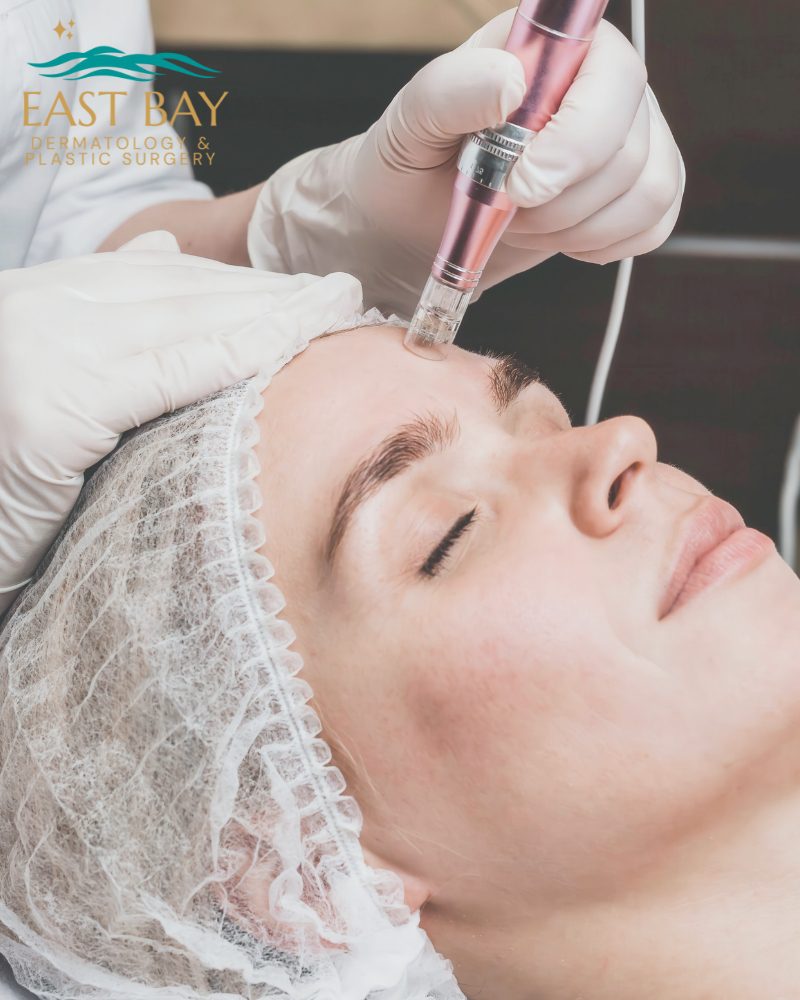 microneedling in bellmore ny