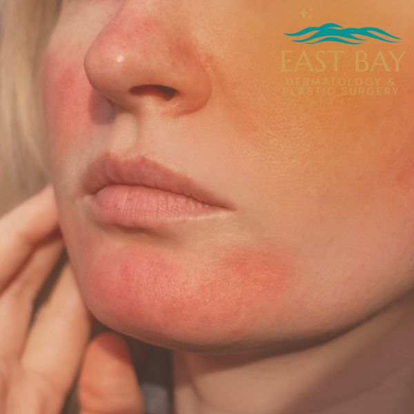 Woman with facial redness from rosacea triggers examined by a Long Island dermatologist